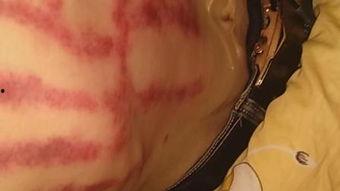 成人中暑扯痧视频,中暑扯痧视频教学，轻松应对高温挑战